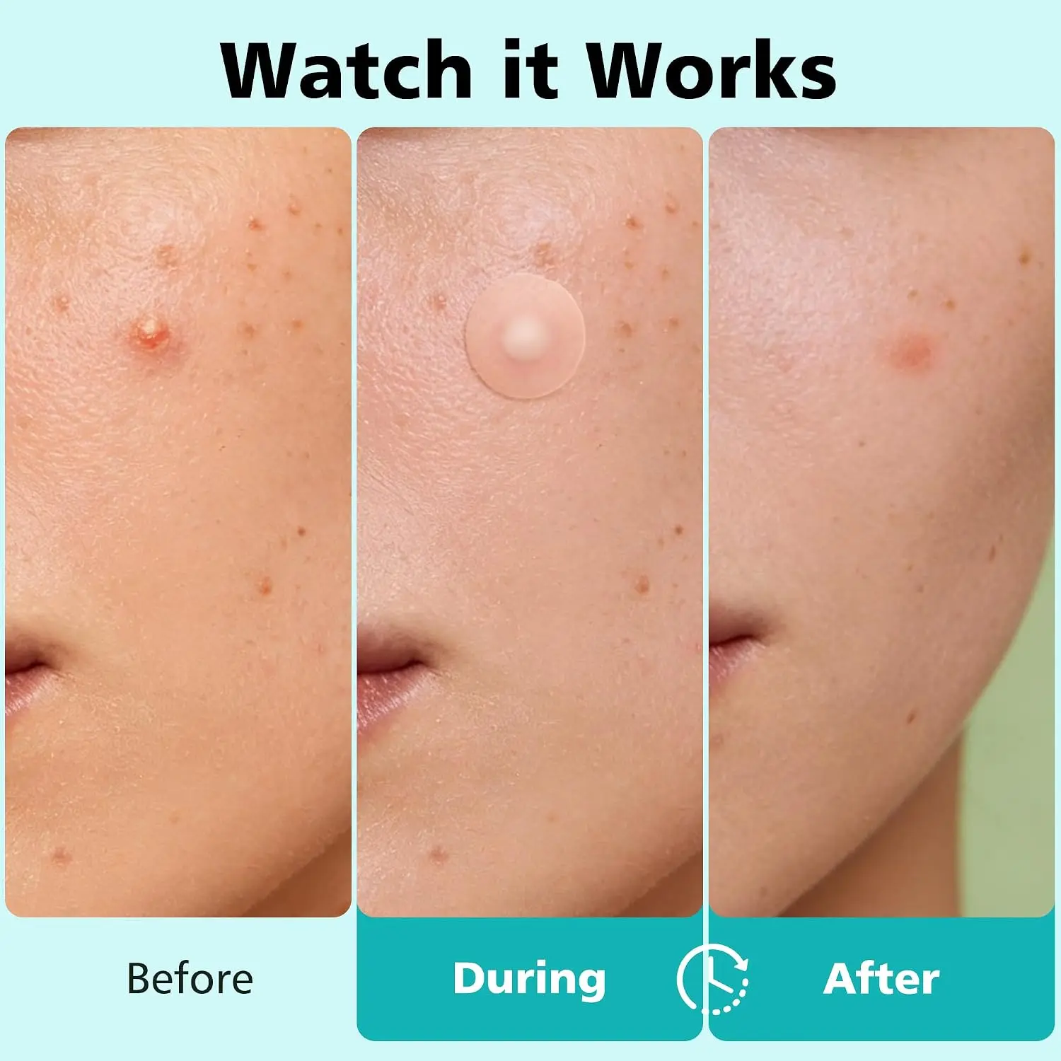 180/360/720 patches/box of hydrogel acne patches can effectively cover acne patches, suitable for both men and women - view 5