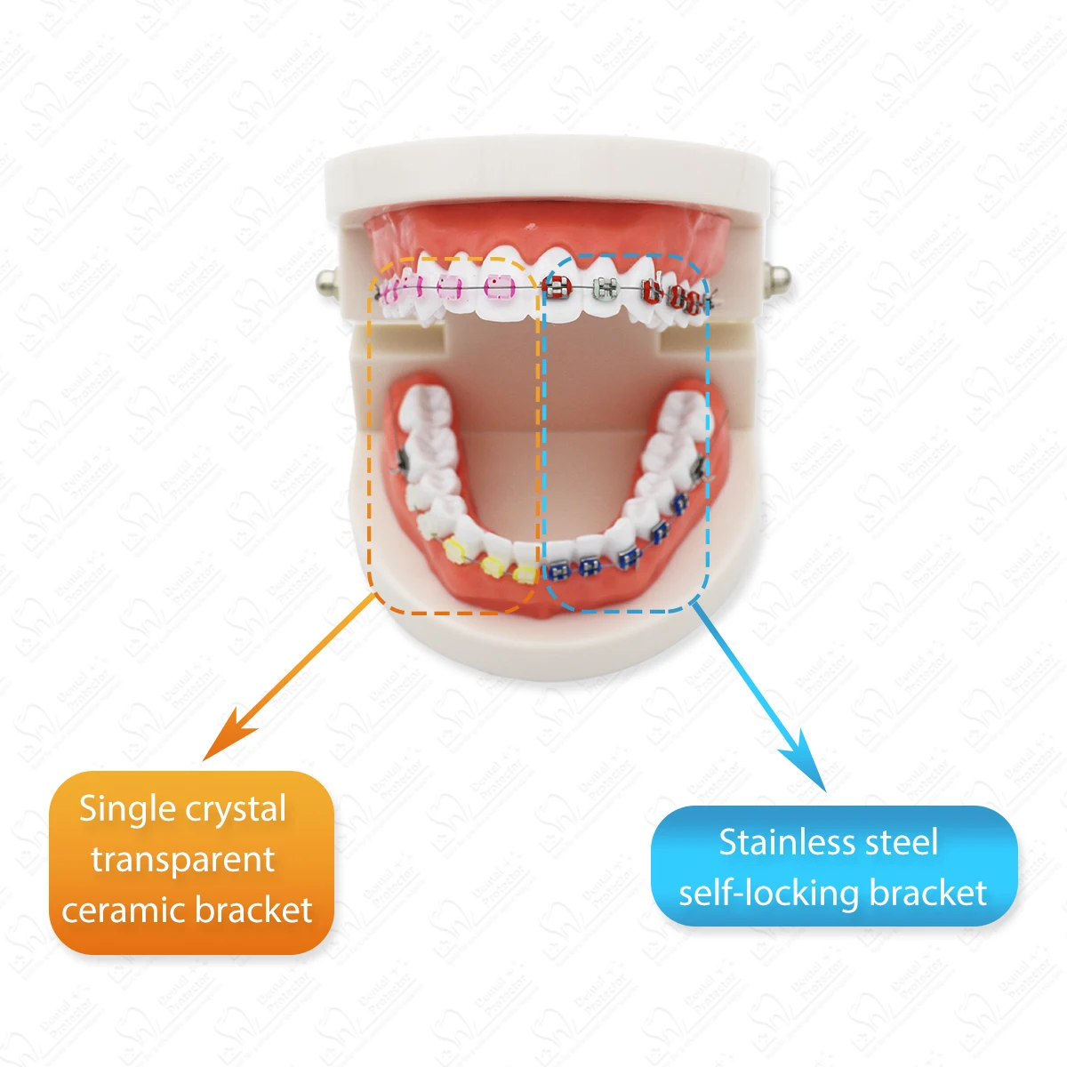 

Orthodontic Teeth Model With Self Ligating Metal Bracket Ceramic Braces Typodont Demonstration Tools For Patient Communication