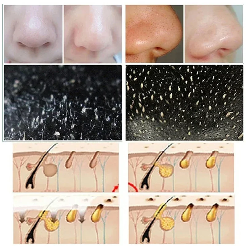 Tiras do nariz para cravos e remoção da acne, desentupimento instantâneo de poros, remendo limpo profundo, cuidados com a pele dos poros