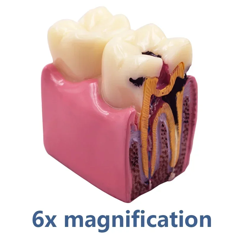 

6 Times Dental Caries Model Disease Teeth Model for Demonstration Model Dentist Teaching Dental Lab Oral Research