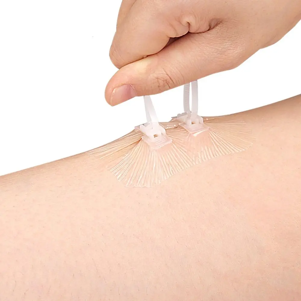 

Клей для ухода за ранами, шовки на молнии, платья без швов, первая помощь, застежка-молния, ремонт лазерции, аварийный ремонт лазерции