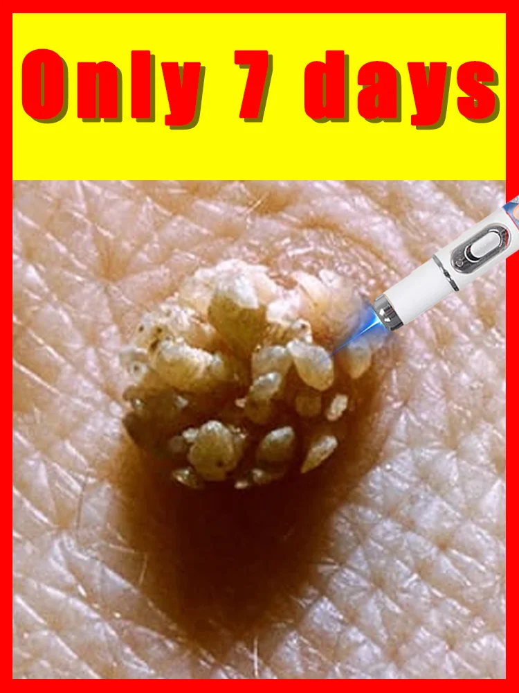 

blue light pen solve warts,Free shipping,wart care tools,unisex,home use