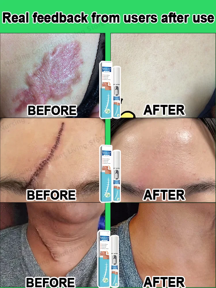 Laser scar repair products