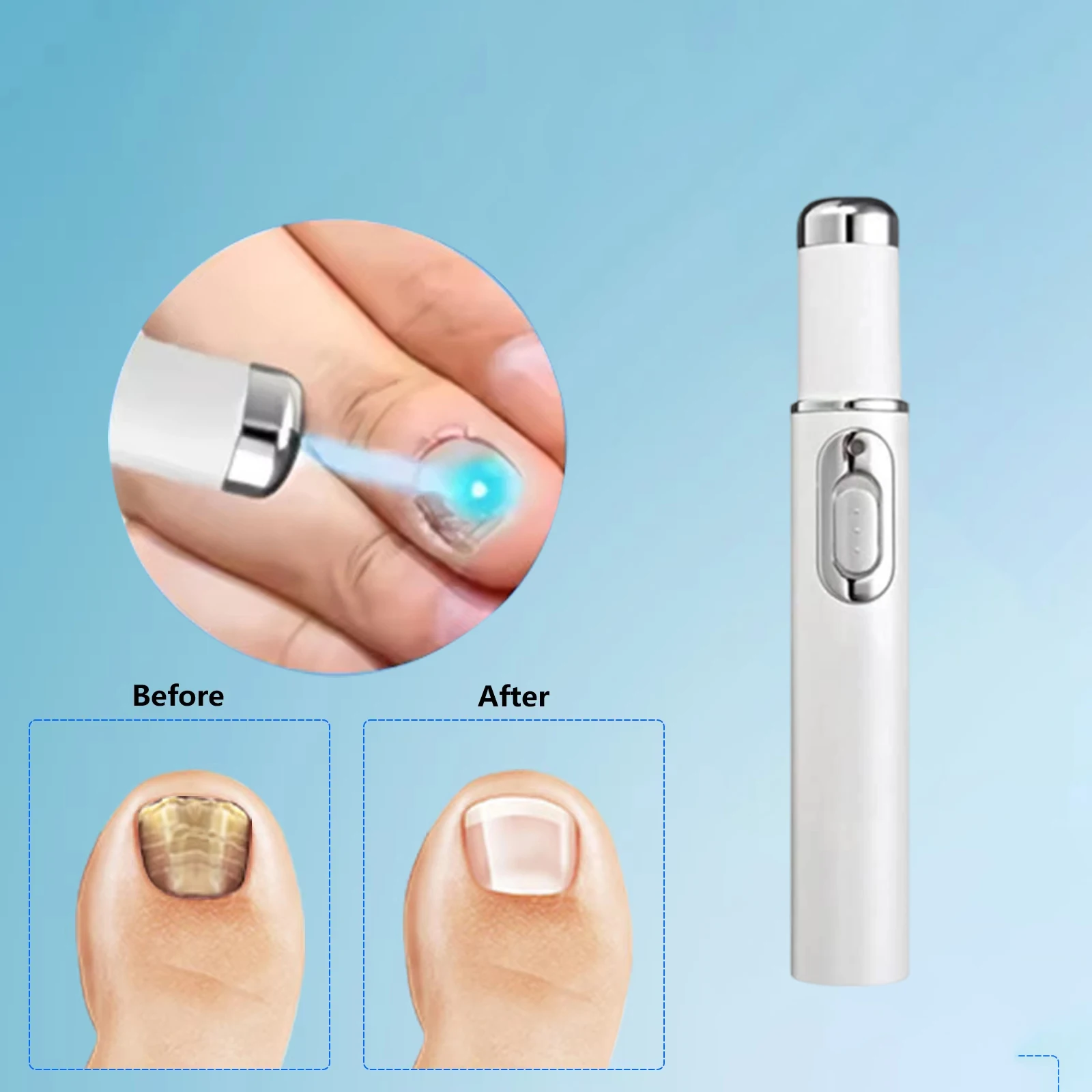 جهاز ليزر فطريات الأظافر علاج الأظافر الفطرية إصلاح فطار أظافر أظافر يزيل باديكير العناية بالقدم الفطريات نام