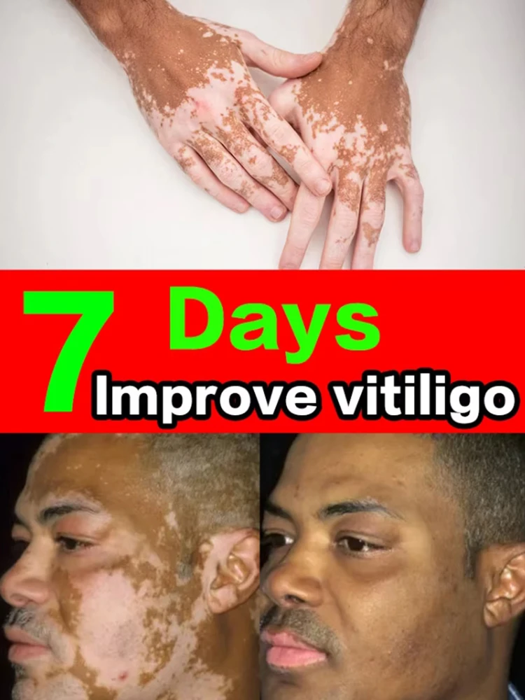 zz Vitiligo Cream Natural Relief Skin Treatment Soothing White Spot Removal Vitiligo Cream Eliminate Pigment White Spot  Removal