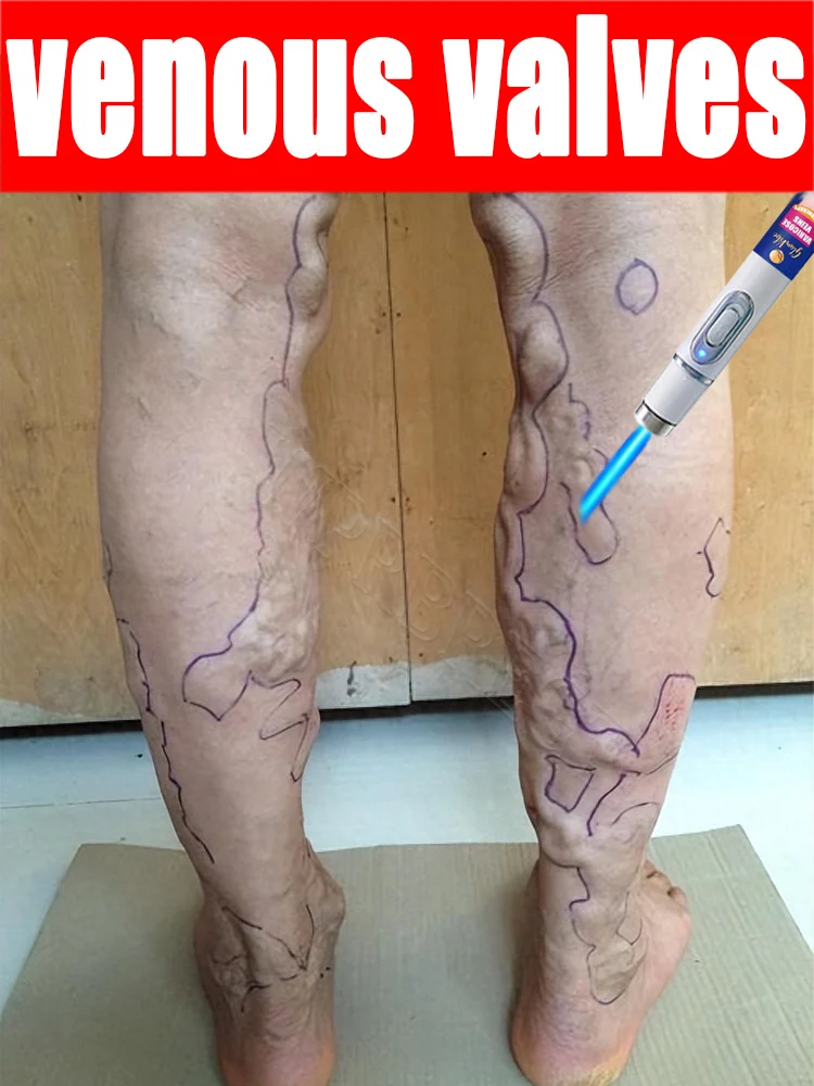 

100% effective against venous valves