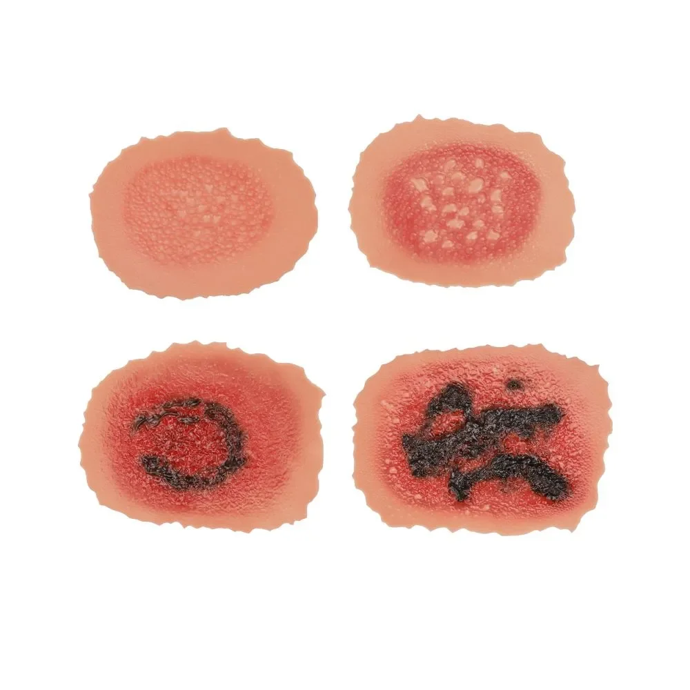 Ultrassist Burn Wound Moulage Model 1st-4th Degree Adhesive Skin Burn Wound Packing Trainer Kit for Medical Students Care Train