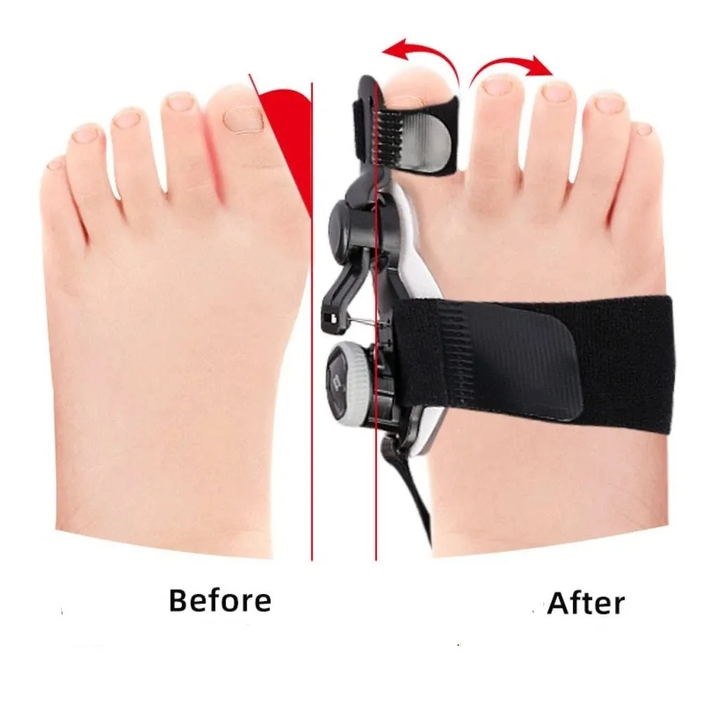 

Регулируемый детский корректор бурсита бурсита стопы, шина для вальгусной деформации большого пальца ноги, выпрямитель для суставов, поддержка вывиха, перелома