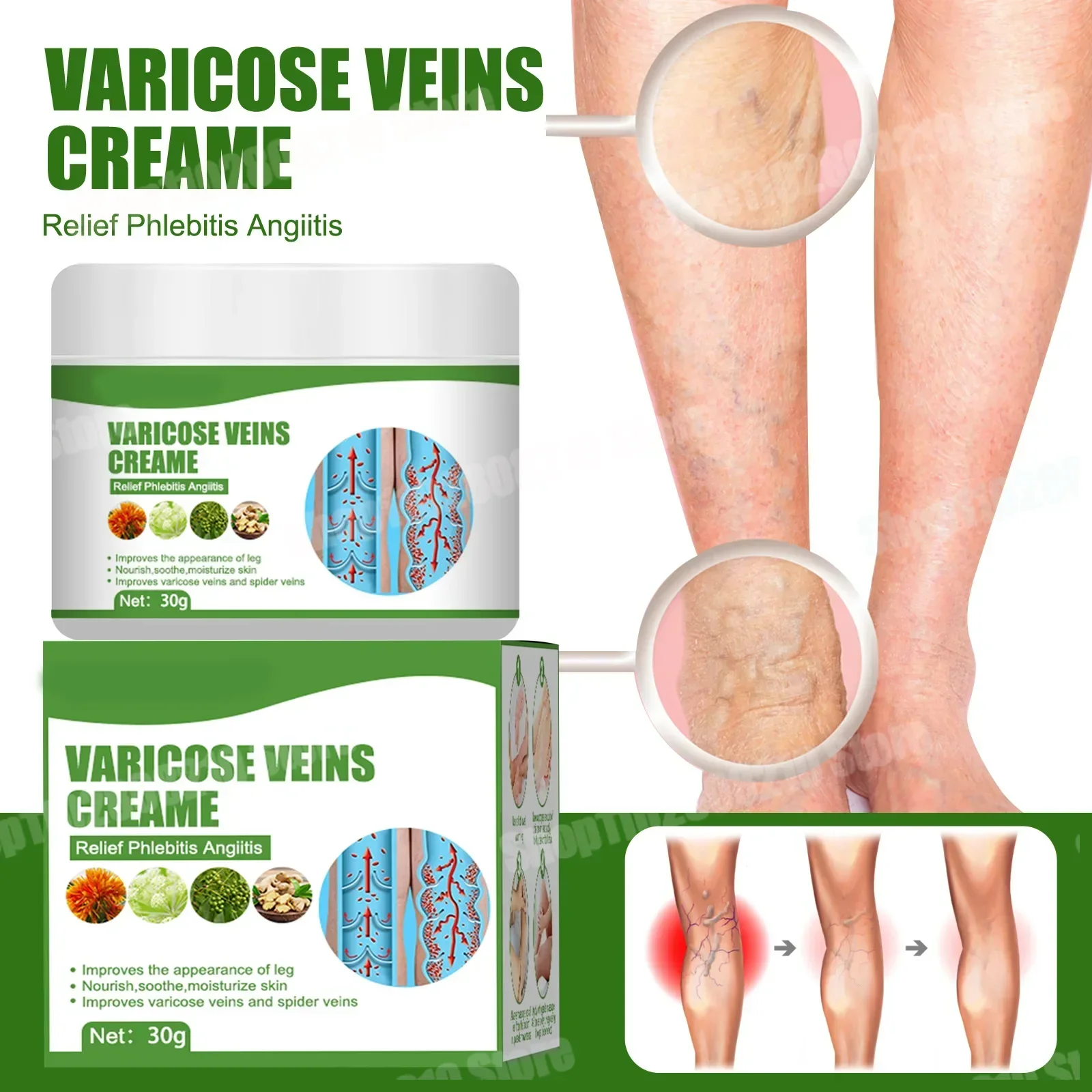 Creme de tratamento de veias varicosas, remove estrias vermelhas no sangue, varicocélula, vasculite, flebite, fortalece a saúde capilar