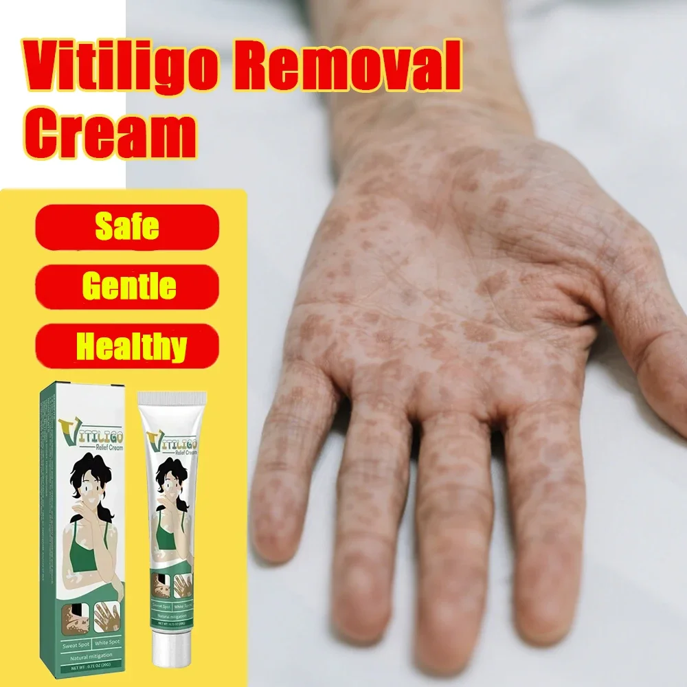 

Vitiligo Removal Cream White Spot Care Cream Skincare cream vitiligo skin Sweat spot Reduce white spots Skin care