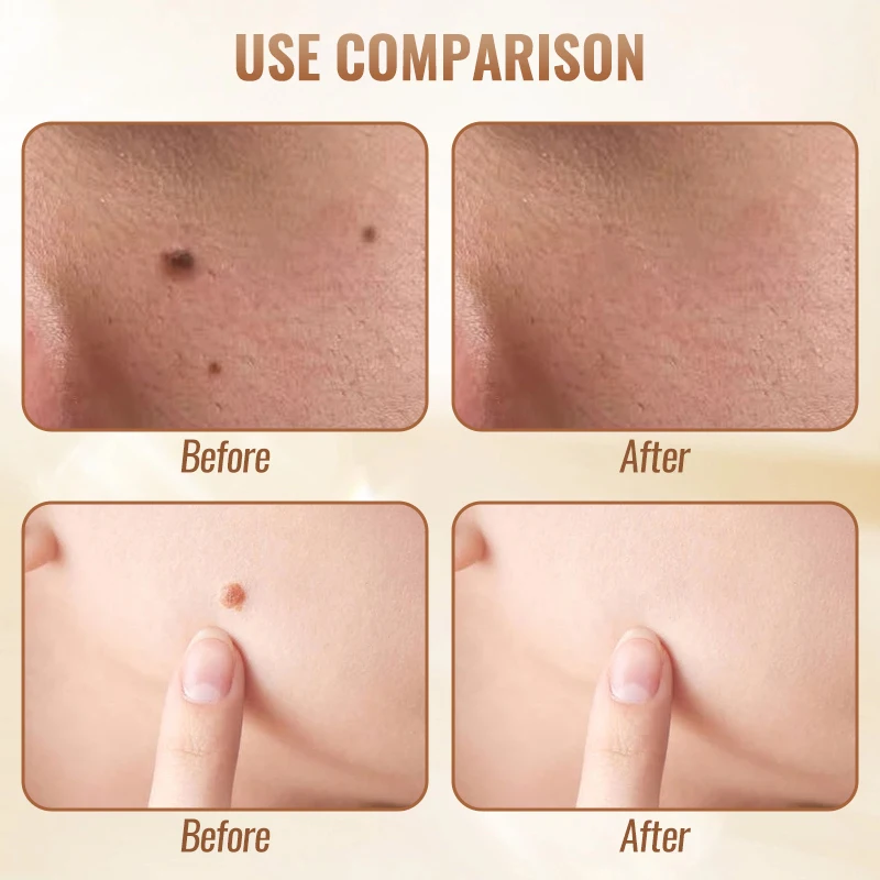 Professional Skin Mole Pen Remover 9 Adjustable Strengths for Sensitive Skin Anti-Burn Technology Quick Recovery Ideal for Face