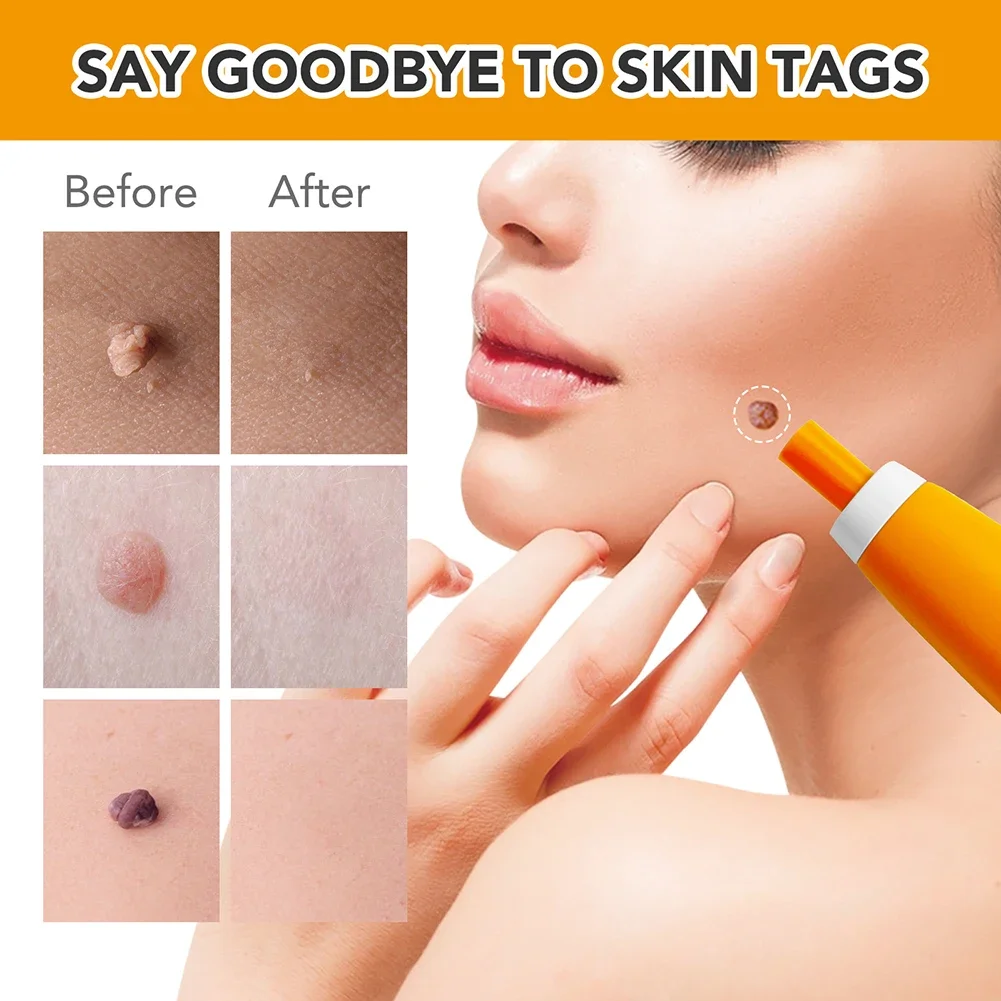 2 IN 1 Auto Micro Skin Tag Remover Device Standard And Micro Skin Tag Removal Kit Adult Mole Wart Remover Face Care Beauty Tools image 4
