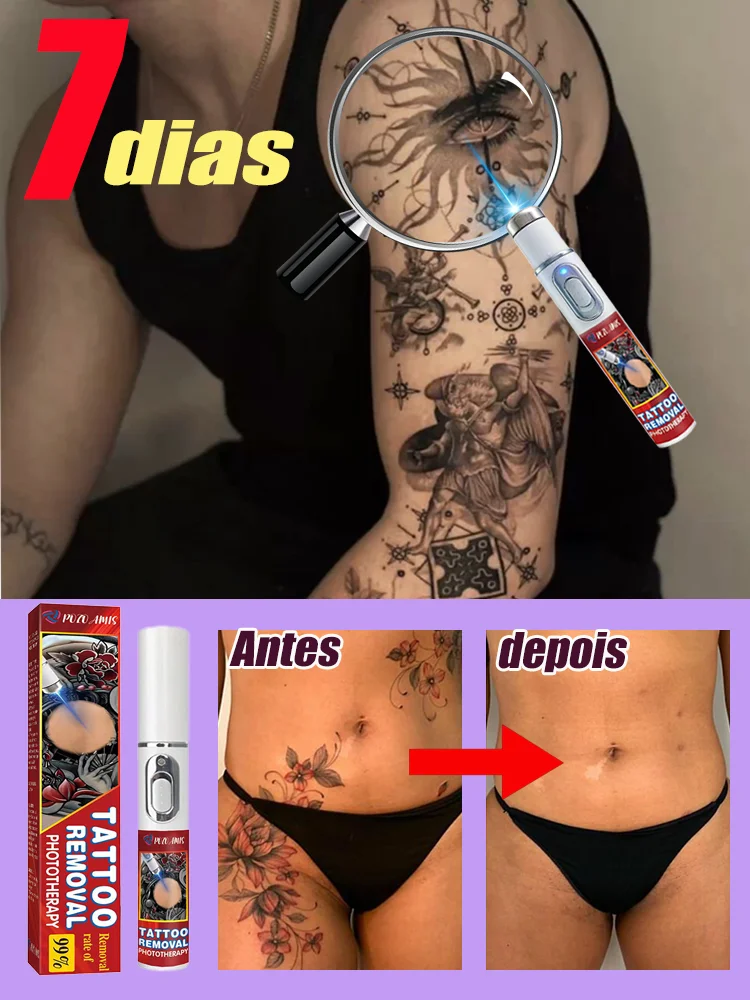 penna-laser-per-rimozione-tatuaggi-rimuove-tatuaggi-grandi-e-piccoli-rimuove-efficacemente-tatuaggi-permanenti