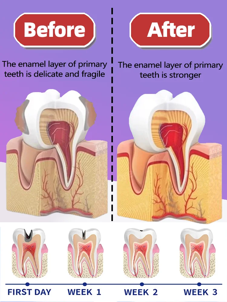 Diente de caries Caries curación anti caries