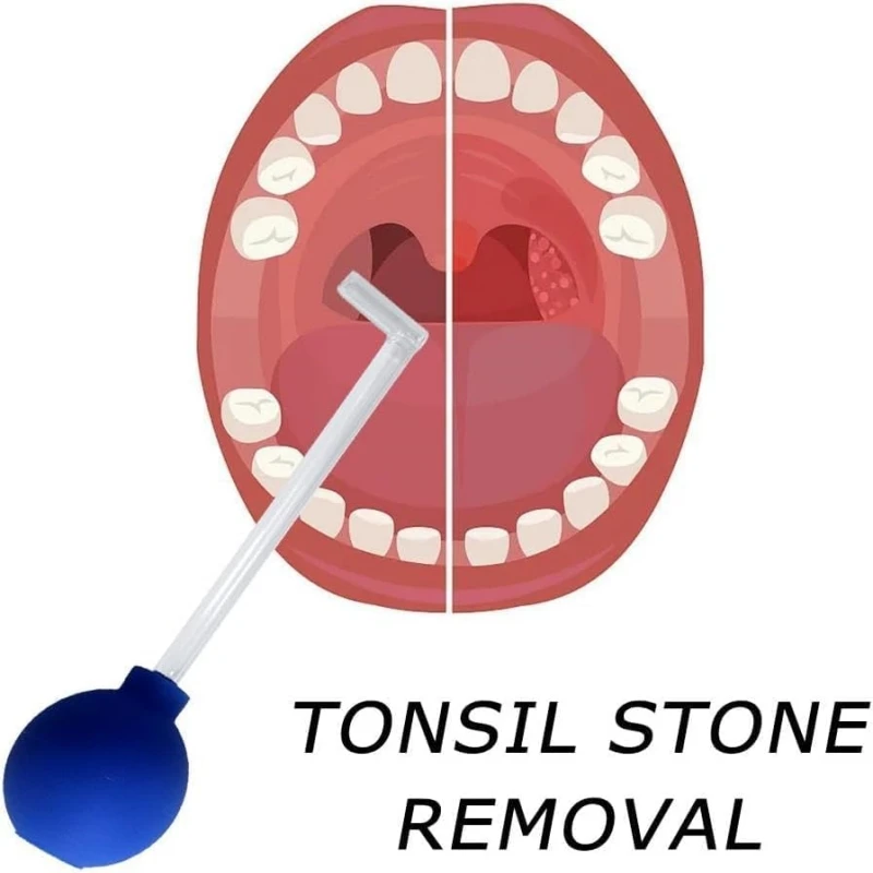 Tonsil Stone Remover Manual Style Oral Cleaner Tonsil Stone Removal Vacuum Kit Mouth Cleaning Suction Cupping Tools for Adults