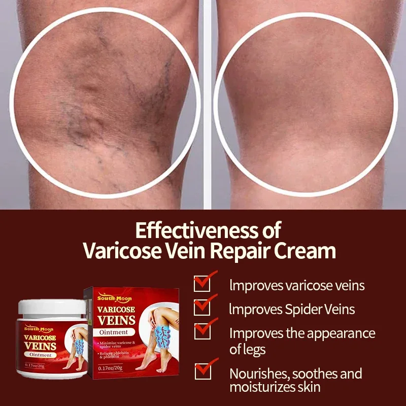 Crema para tratamiento de venas varicosas, 5 piezas, cuidado de los pies, varicosidad de las piernas, angitis, Vasculitis dilatada, flebitis, medicina para aliviar