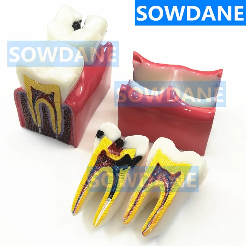 

1pc Dental Anatomy Education Teeth Model 6 Times Caries Comparation Study Models For Dentist Studying and Researching