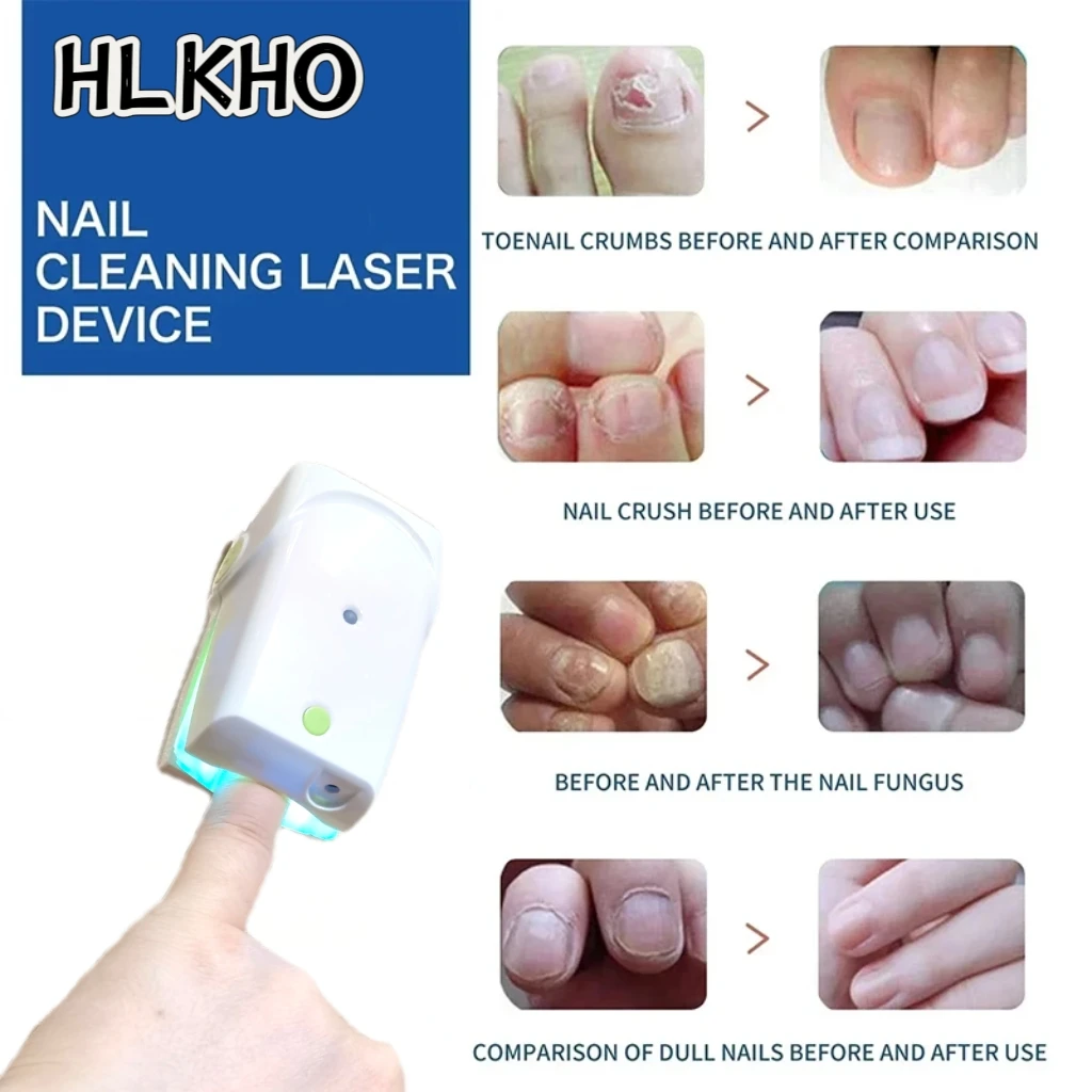 

Перезаряжаемый аппарат для лечения грибка ногтей, синяя светотерапия HLKGO 470 нм и 905 нм для очистки и восстановления при онихомикозе