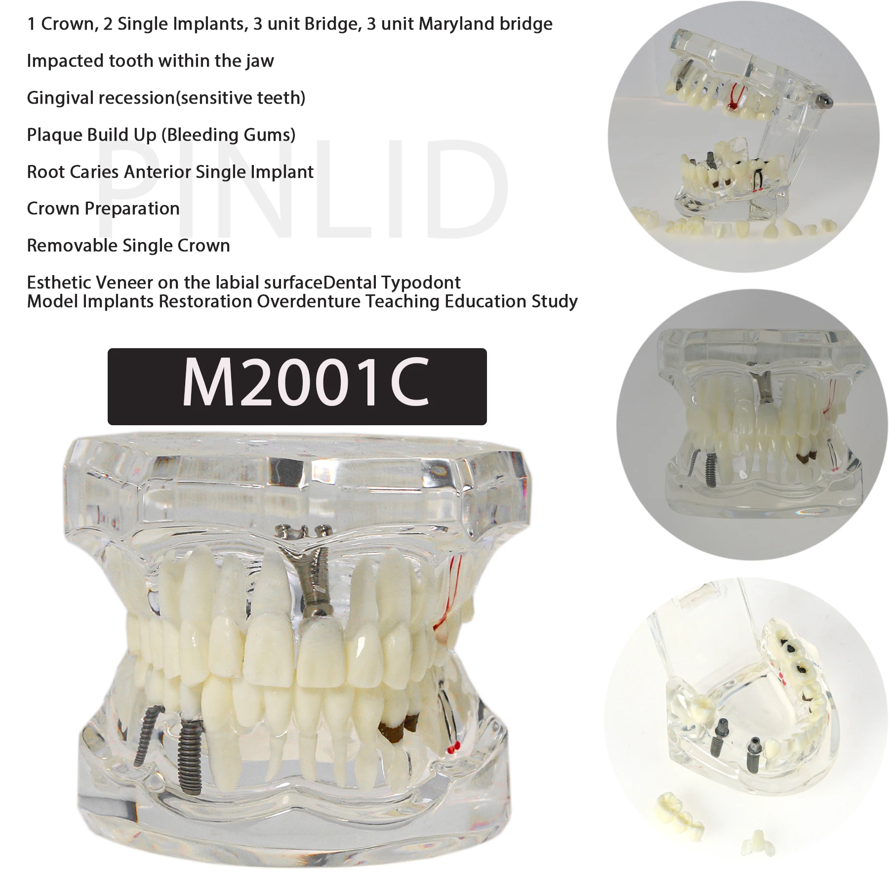 Dental Implant Restoration Pathology Teach Study Teeth Model M2001C Practice Training Dental Teaching Learning Demonstration