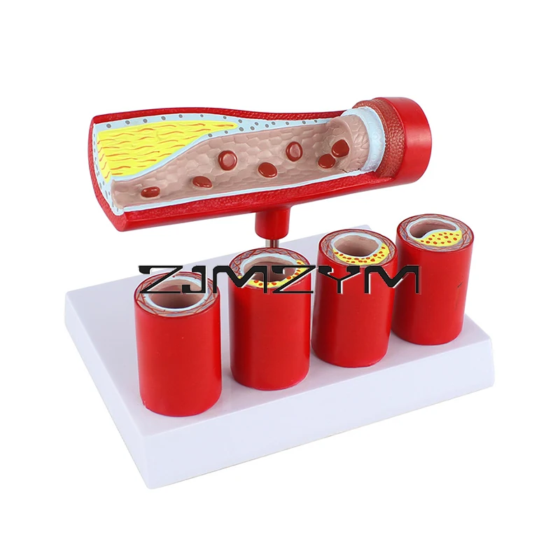 

Сердечно-сосудистые артерии, модель коронарной артериформы для пожилых людей, модель тромбоза при склерозе ветвей