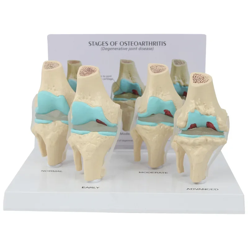 Knee Joint Model Set Human Body Anatomy 4-Stage Osteoarthritis Knee Joint for Doctors Office Educational Tool