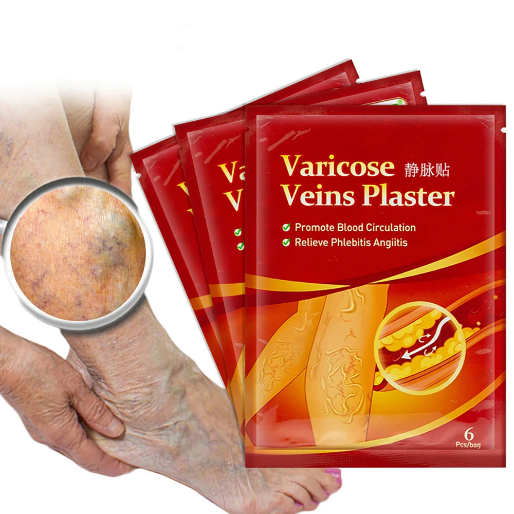 

6/12/18/24/30pcs Varicose Veins Plaster Vasculitis Phlebitis Spider Cream Varicosity Angiitis Removal Herbal Medical Plaster