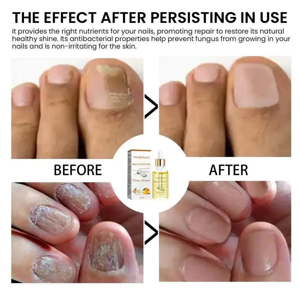 

Sdottor Nail Strengthening Oil Moisturizing Cuticle Oil for Healthier Nails Natural Ingredients Fast Results Natural Nail Treatm