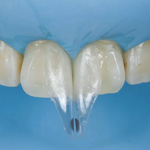 Imagen 2 del producto Matriz transparente de transparente frontal Dental, 5 piezas, se adapta a BioClear S1/2/3