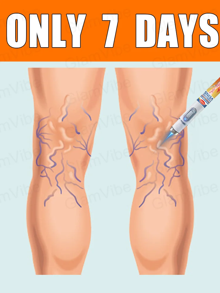 

Generation-2 Laser Says Goodbye To Spider Legs Varicose In 7 Days