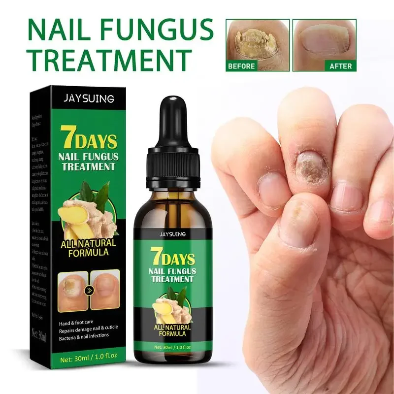 

30ml Fungal Nail Treatment Essence Oil Nail Fungus Laser Device Repair Toenail Fingernail Treatment Onychomycosis