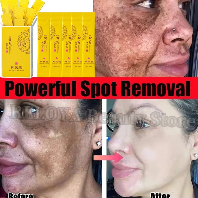 Powerful Spot-removing Whiten Cream Brighten Skin Fast Removal Pigmentation Melasma Dark Spot Fade Melanin Beauty Moisturize Gel