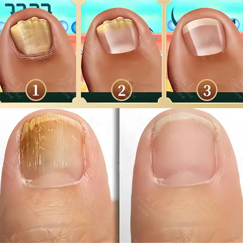 7 Days Nail Fungus Treatment Serum Ginger Anti-Infective Paronychia Onychomycosis Toe Foot Nail Fungal Repair Gel Hand Foot Care