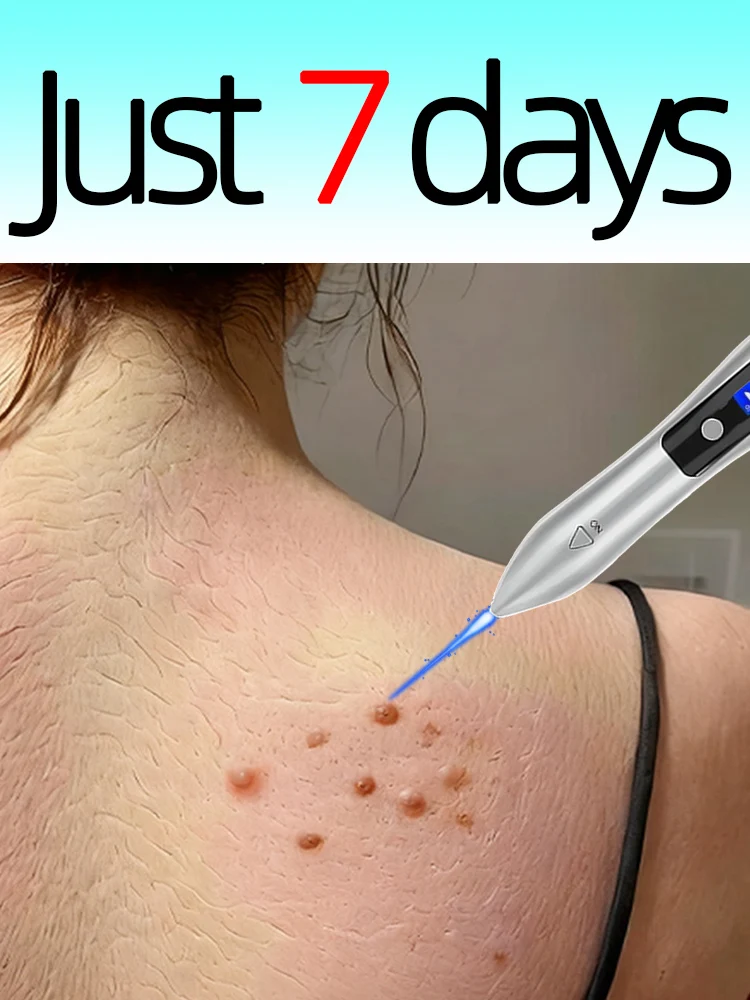 

Solve Wart Tools Blue Laser Pointer and laser tool