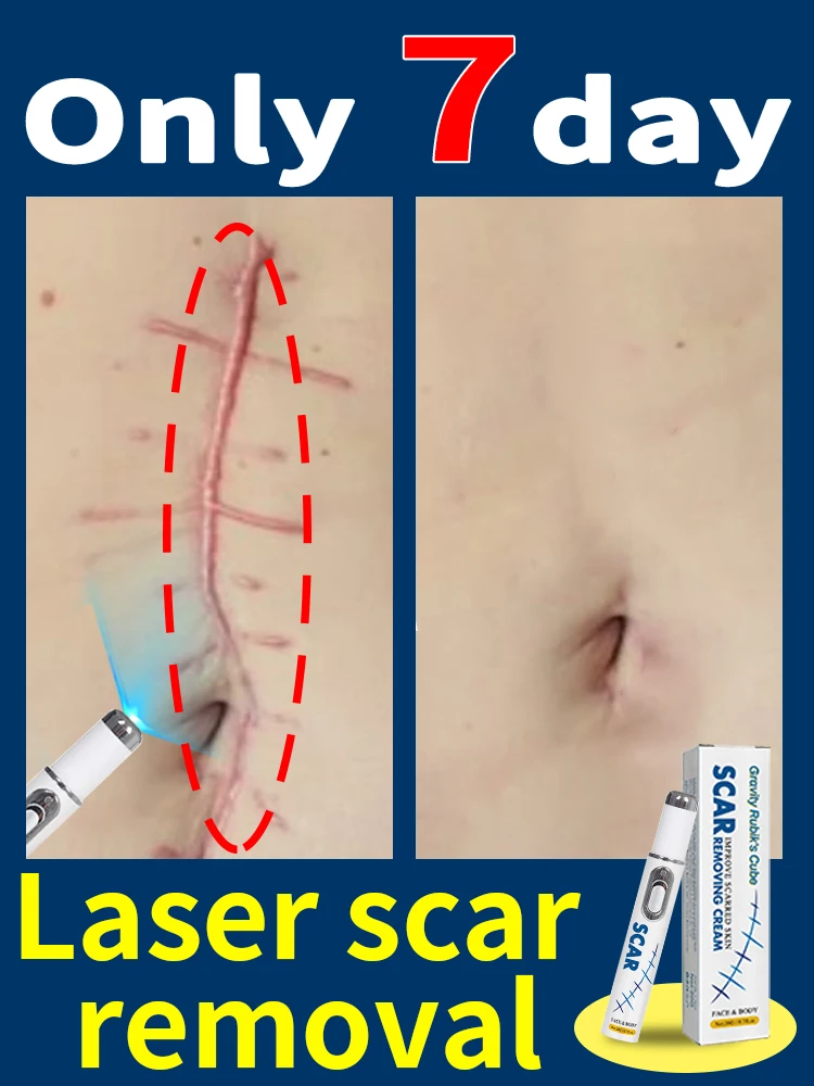 

Hot Selling Laser Scar Repair Keloids