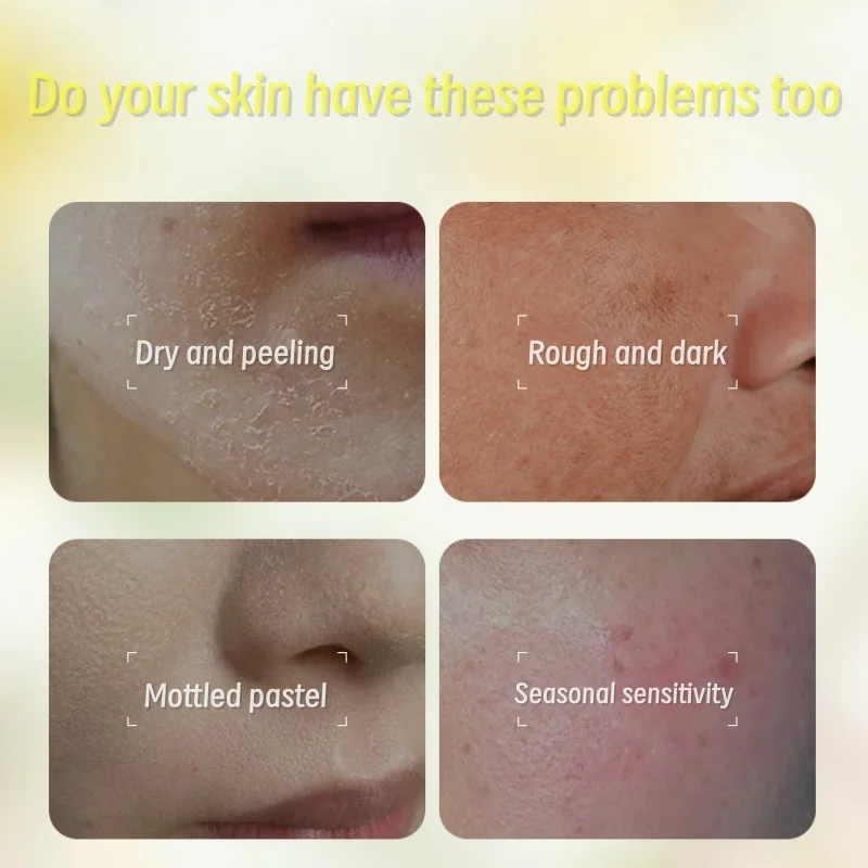 Крем от облипиха с натуральным растительным экстрактом, эффективный восстанавливающий и успокаивающий, глубоко увлажняющий и освежающий антипригарный крем для лица