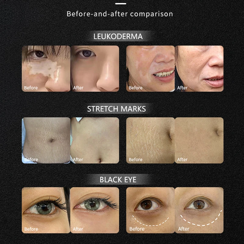 Permanent Makeup Machine for Skin Camouflage Professional Wireless Tattoo Machines for Skin Scar Stretch Marks Tattoo Supplies