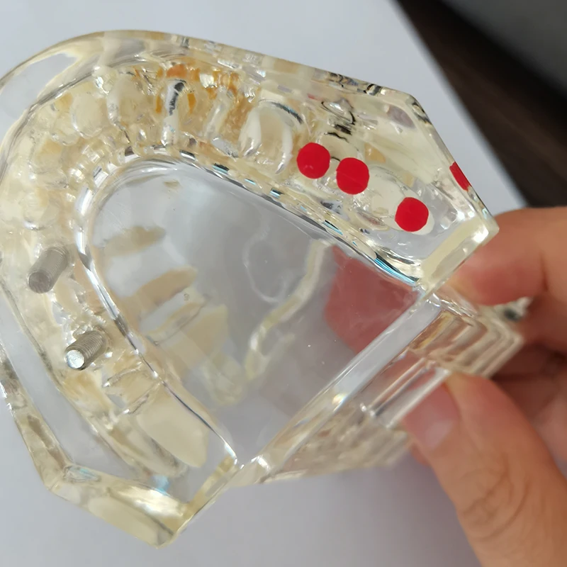 1PCS Dental Disease Teaching Teeth Model Implant False Tooth Transparent Pathological Repair Training Study Demonstration Model