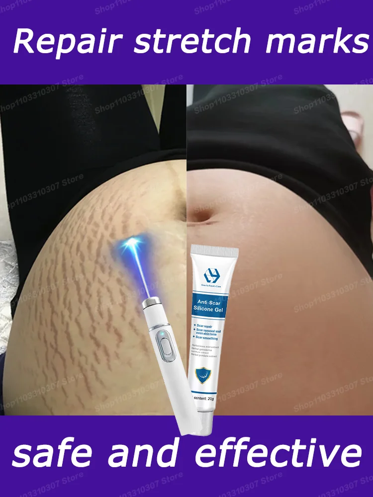 Improve Red White Old Stretch Marks Blu-ray Pen