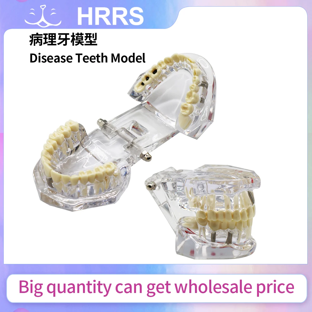 

Implant Dental Disease Teeth Model With Restoration Bridge Tooth For Medical Science Dental Disease Teaching Study Tool