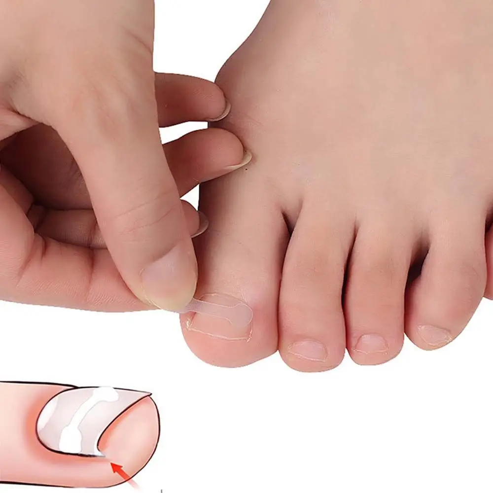 Parche ortopédico para corrección de uñas, herramientas de pedicura, pegatinas para uñas encarnadas