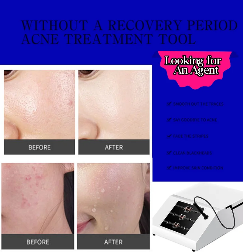 

Hot Sell RF ACACIA Face Care Blackhead Acne Removal Shrink Pore Skin rejuvenation Salon Use Beauty Machine