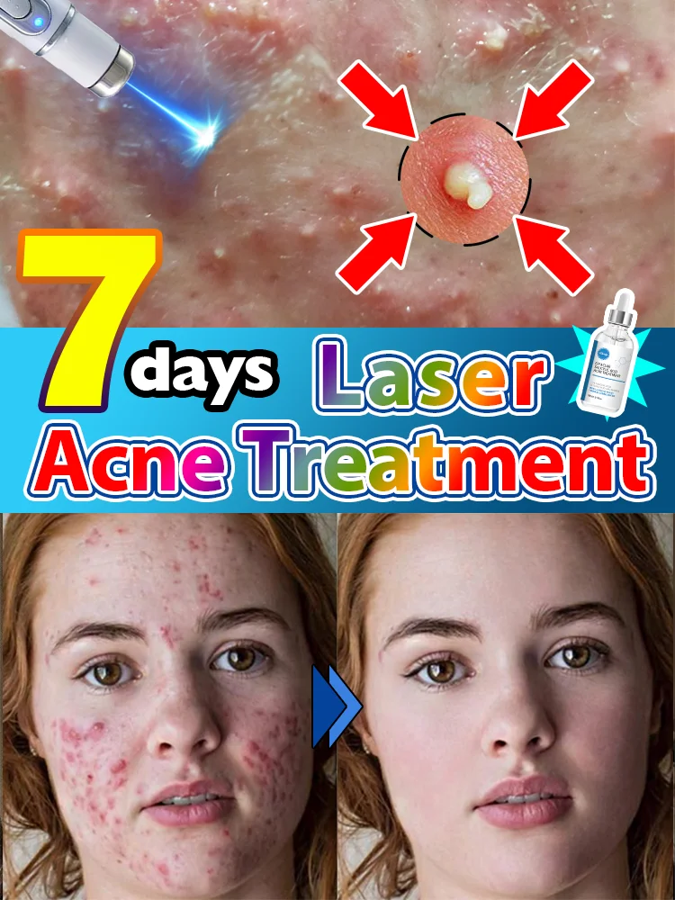 Laser removes acne safely and effectively in a short time