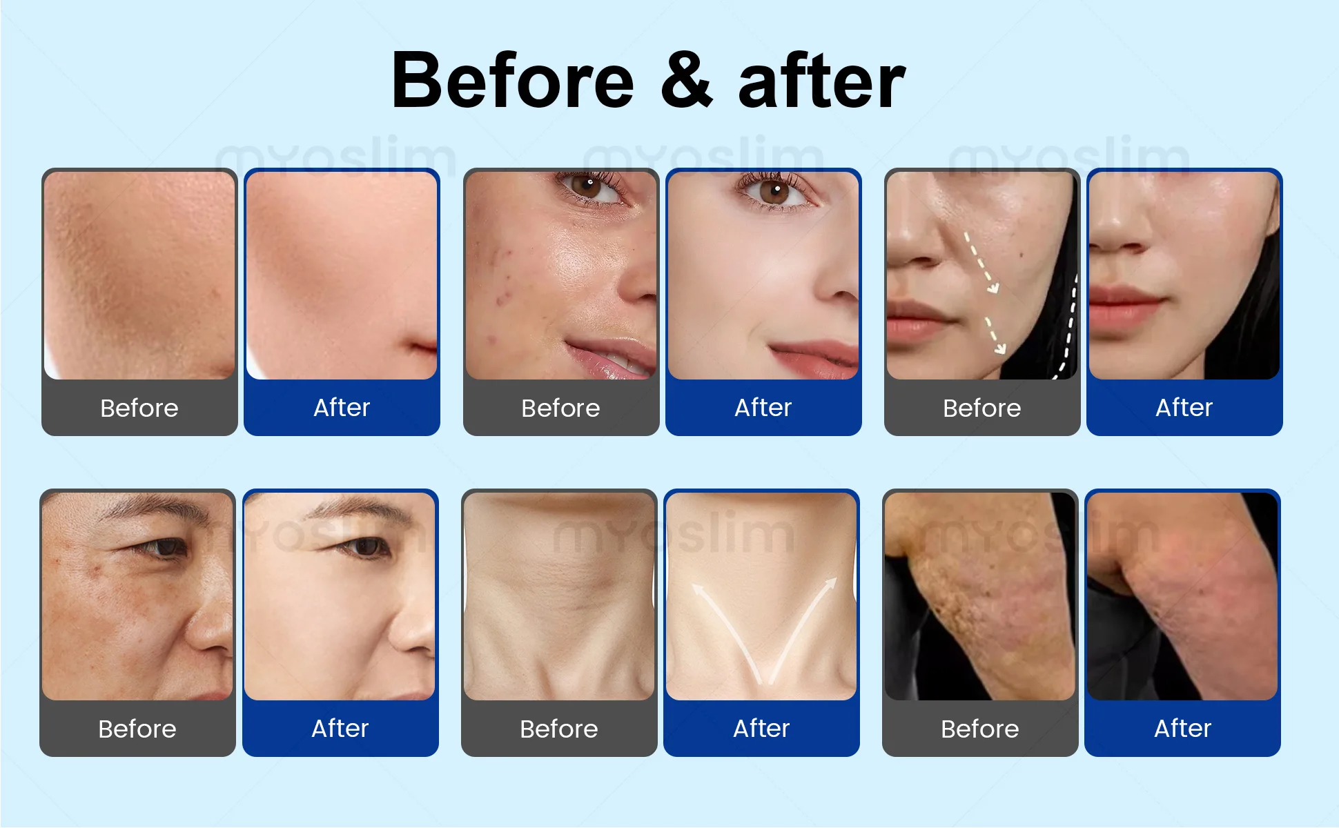 4 in 1 Morpheus8 RF Microneedling Facial Device: Skin Tightening, Anti-Aging, Wrinkle Reduction Tool