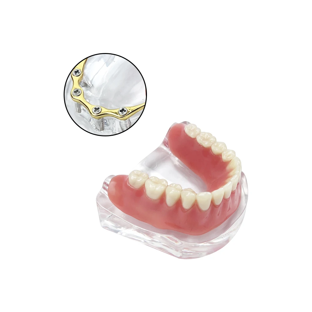 Removable Overdenture Teeth Model With 4 Implants Lower Jaw Bridge Teaching Demo for Dentist Patient Golden/Silver Bar Model