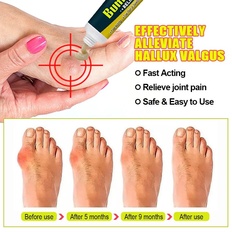 3Pcs Foot Gout Treatment Cream Thumb Corrector Finger Hallux Ointment Toe Bunion Pain Relieve Medical Plaster Health Care A1790