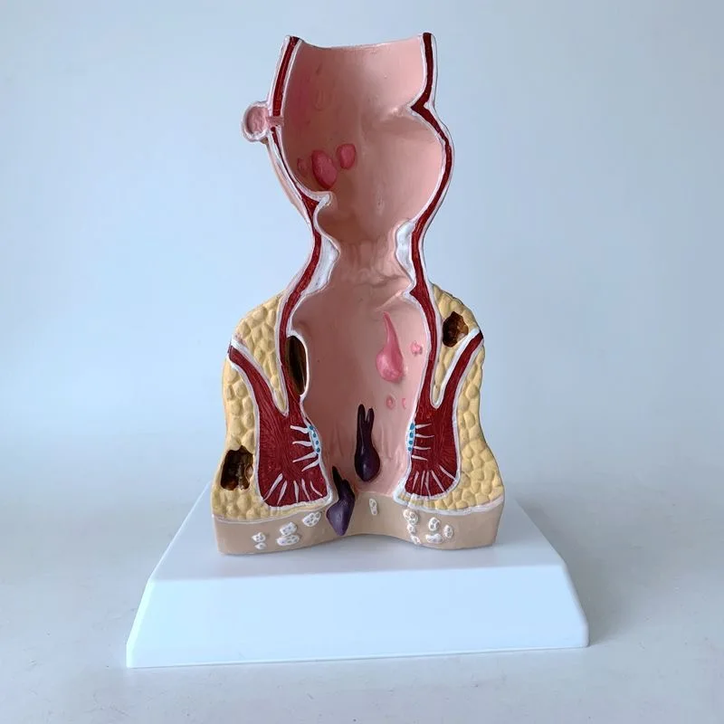 Human Colorectal Model Rectal Pathological Hemorrhoid Model Anal Fistula Anatomical Model
