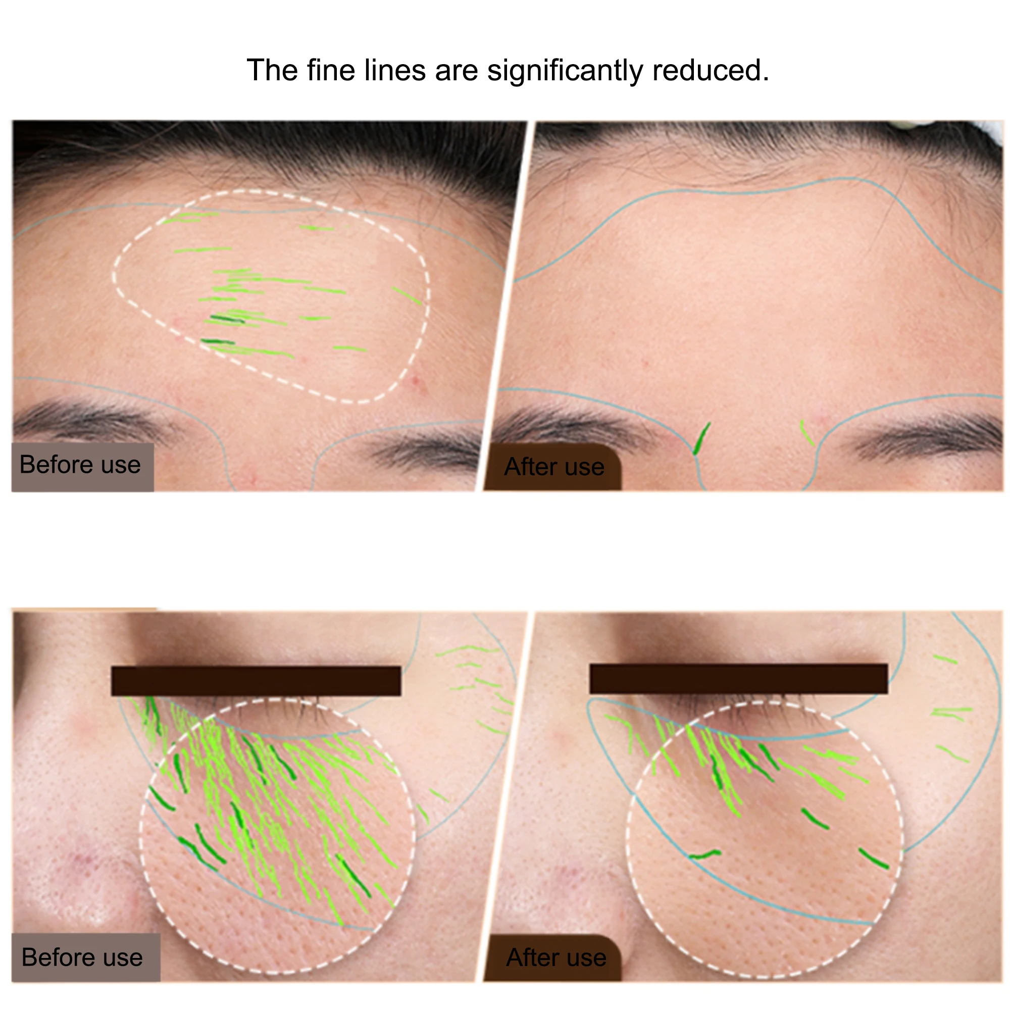 Profesjonalne urządzenie do pielęgnacji skóry w domu, RF, przeciwstarzeniowe, EMS, do twarzy i ciała, radiofrekwencja, ujędrnianie skóry, lifting twarzy, urządzenie kosmetyczne RF.