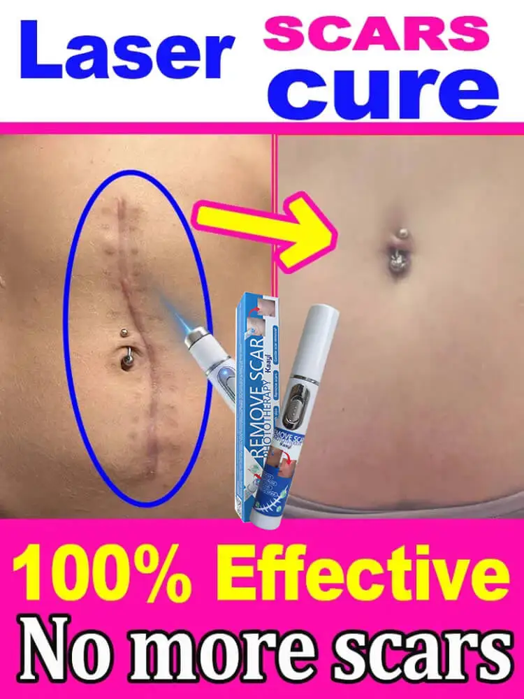 

Recovery Scar Fast Remove Deep Skin Scar Acne Stretch Marks Burn Keloid Spot Treat scar laser Smooth Whiten Face Skin Care