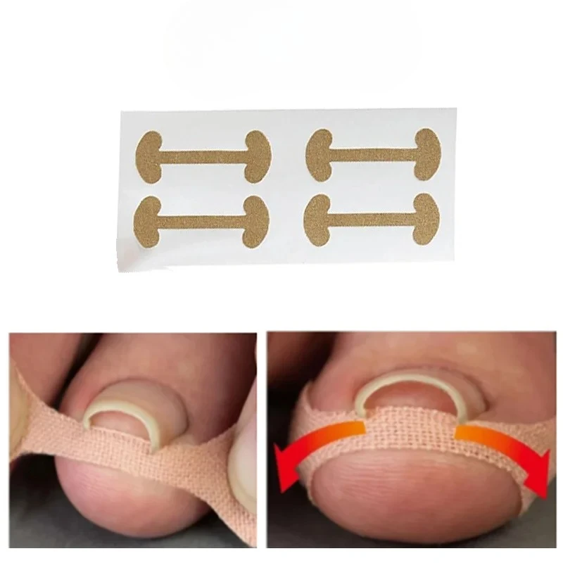 

Профессиональные корректирующие наклейки для вросших ногтей на ногах, для ухода за ногтями, педикюра, коррекции вальгусной деформации большого пальца
