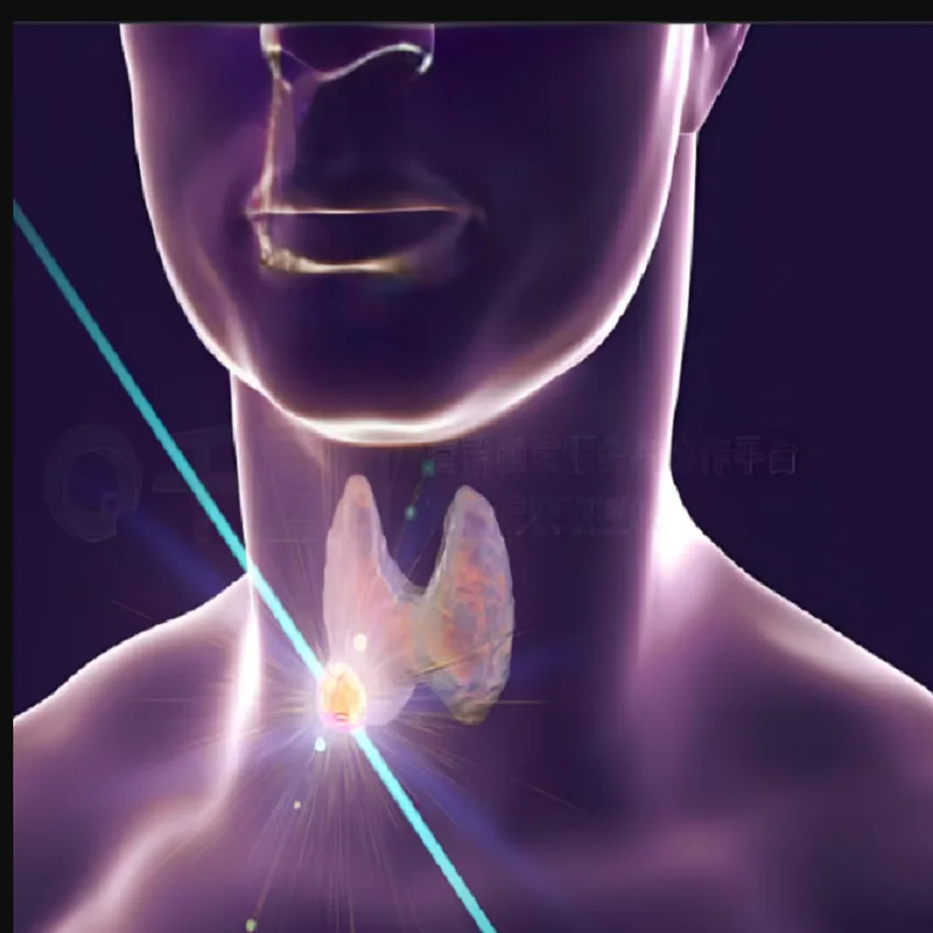

Laser therapy for thyroid nodules